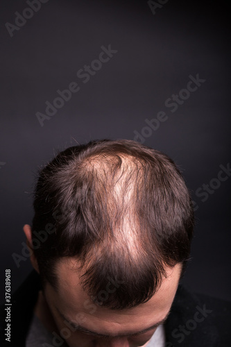 Male head close-up with baldness. Studio black background.