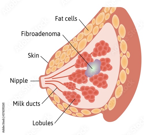 Cyst in the female Breast. Large fluid filled cyst located among lobules. Medical vector illustration marked with lines.