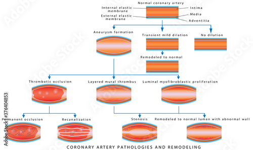 Coronary Artery Pathology. Arterial Remodeling. Medical illustration of Coronary Artery Pathologies and Remodeling. Coronary Artery Disease. 
