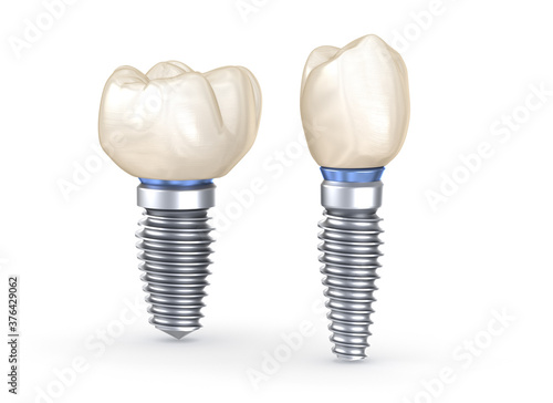 Dental Implants. 3D illustration concept of human teeth