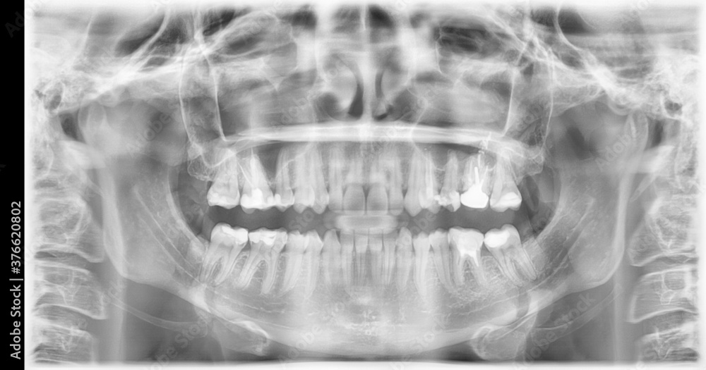 Dental xray of molars, crown, caries, implant. resonance