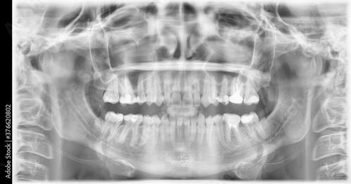 Dental x-ray of molars, crown, caries, implant. Magnetic resonance tomography of the oral cavity for braces.