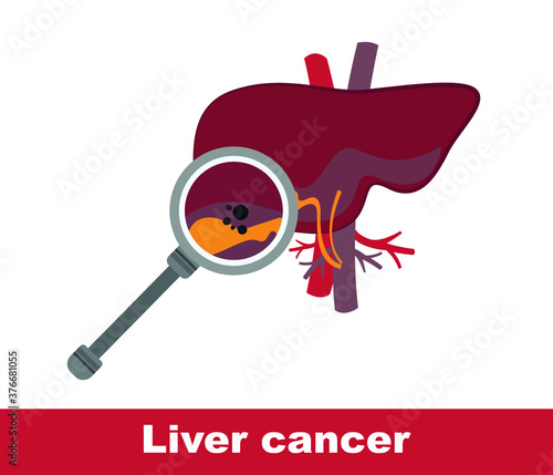 The human liver. cancerous liver flat design icon, vector
