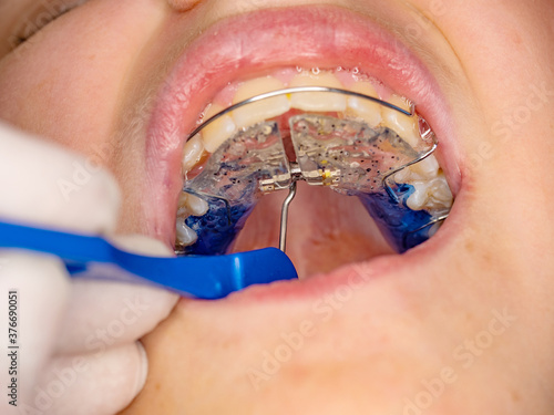Doctor setting  with tool of Hyrax Expander RPE, Especial palatal braces for correction of birth defect. photo
