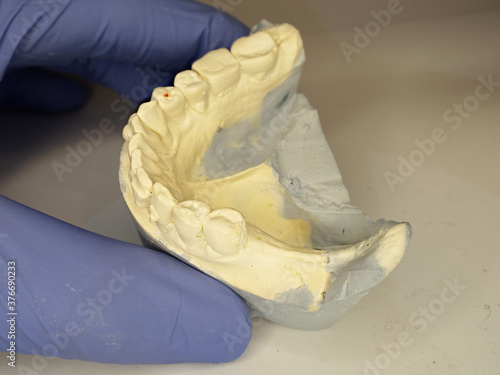 Dental gypsum mold with crooked teeth. photo