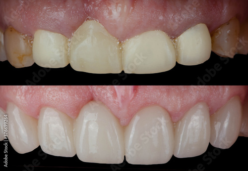 Before and after of covering natural teeth with ceramic veneers 