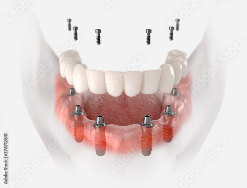 Restoration of mandible with 6 implants. 3D illustration of dental prosthesis on white background.