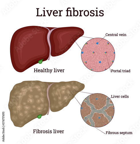 Illustration of Liver Disease - Fibrosis, which is an overgrowth of scar tissue