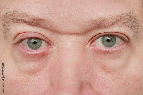 mirada de hombre con ojos azueles y alergia y bolsas en los ojos  photo