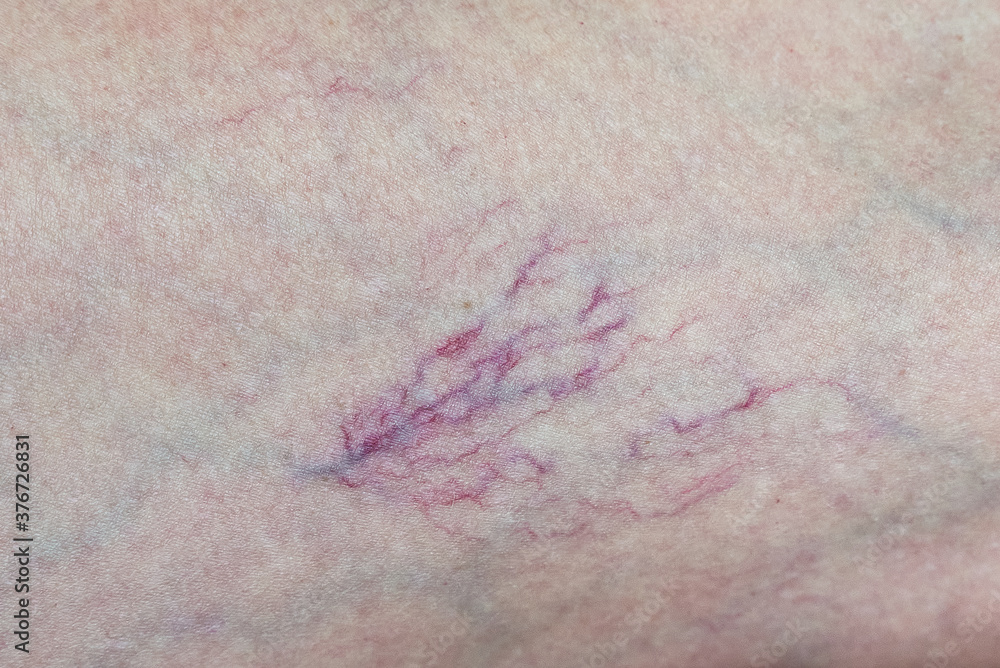 Varicose veins on the leg close-up. The concept of the need for the help of a phlebologist.