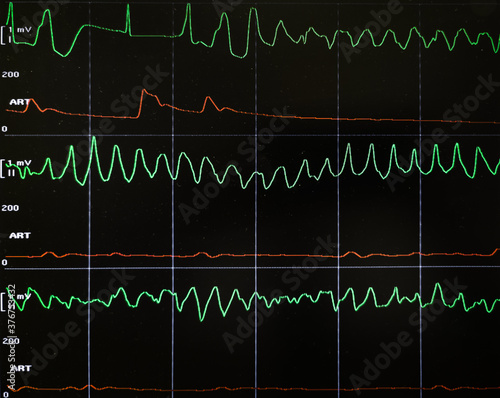 Medical vital sign monitor reading of electrocardiogram (ECG) and invasive arterial pressure: onset of torsades de pointes ventricular fibrillation (VF) with pulse wave fading. Cardiopulmonary arrest.