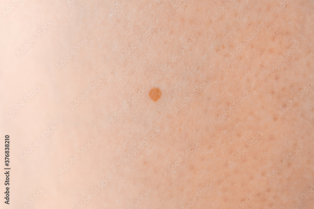 Human skin with mole, closeup Human skin with mole, closeup