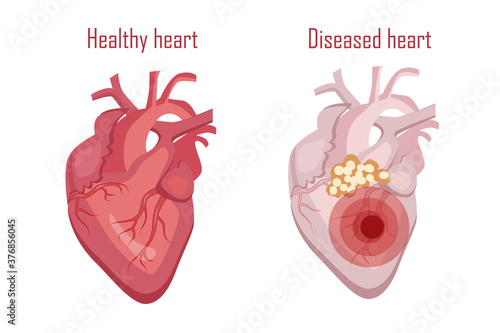 Human heart, circulatory system. Sick and healthy heart, vector illustration
