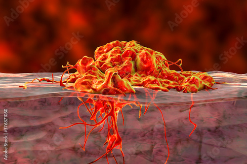 Obraz na plátně Invasive cancer growth
