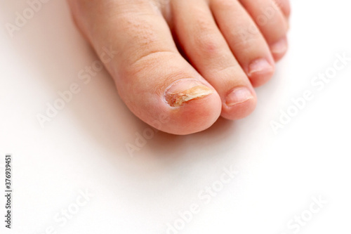 Canvas Print Close-up of toenail with fungus infection