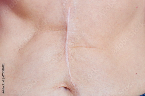 Foto perfect imperfection after a surgical operation