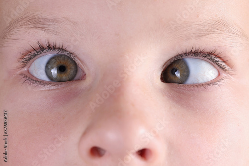 Child's face with squint and freckles on nose. Strabismus in children causes and treatment concept