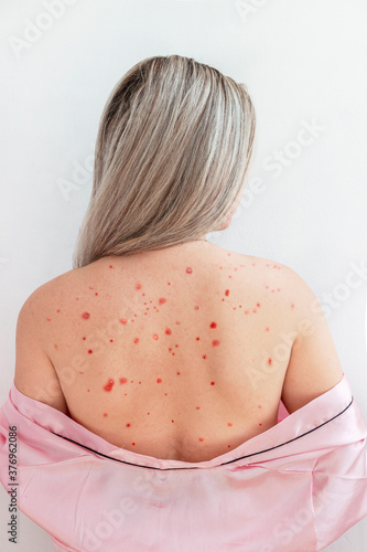 Obraz na plátně chickenpox in an adult girl, pinch on the back