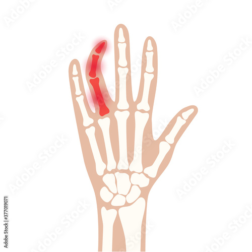Arthrits x ray