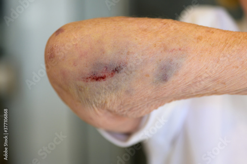 Elderly 80-year old woman with a broken elbow photo