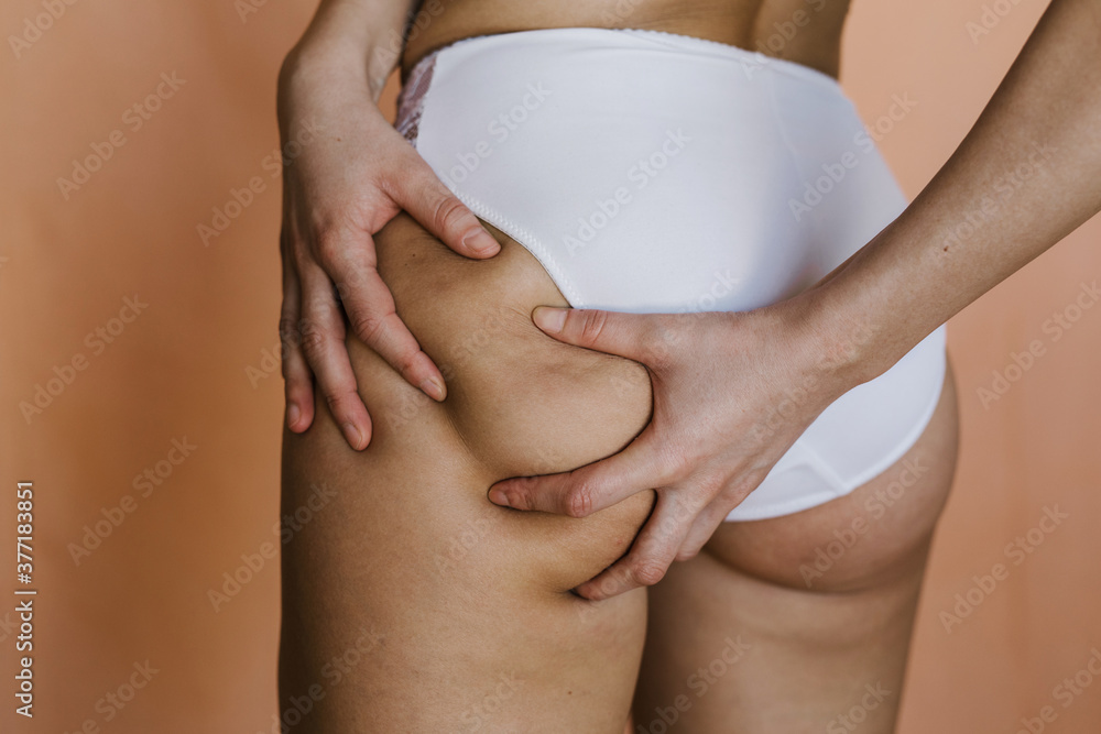 © mihajlo ckovric/Stocksy - Young woman having cellulite © mihajlo ckovric/Stocksy - Young woman having cellulite