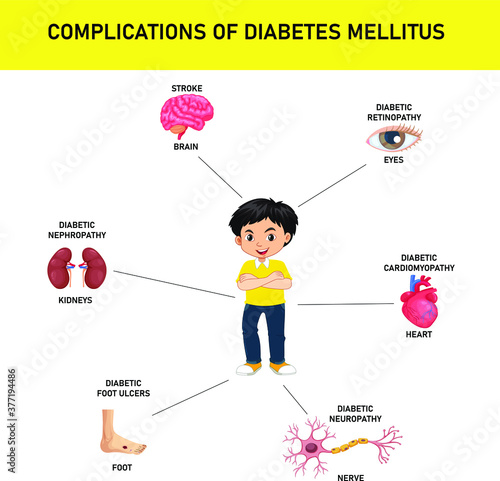 Complications of diabetes mellitus with stroke, nephropathy, neuropathy, foot ulcers, cardiomayopathy, peripheral neuropathy, retinopathy