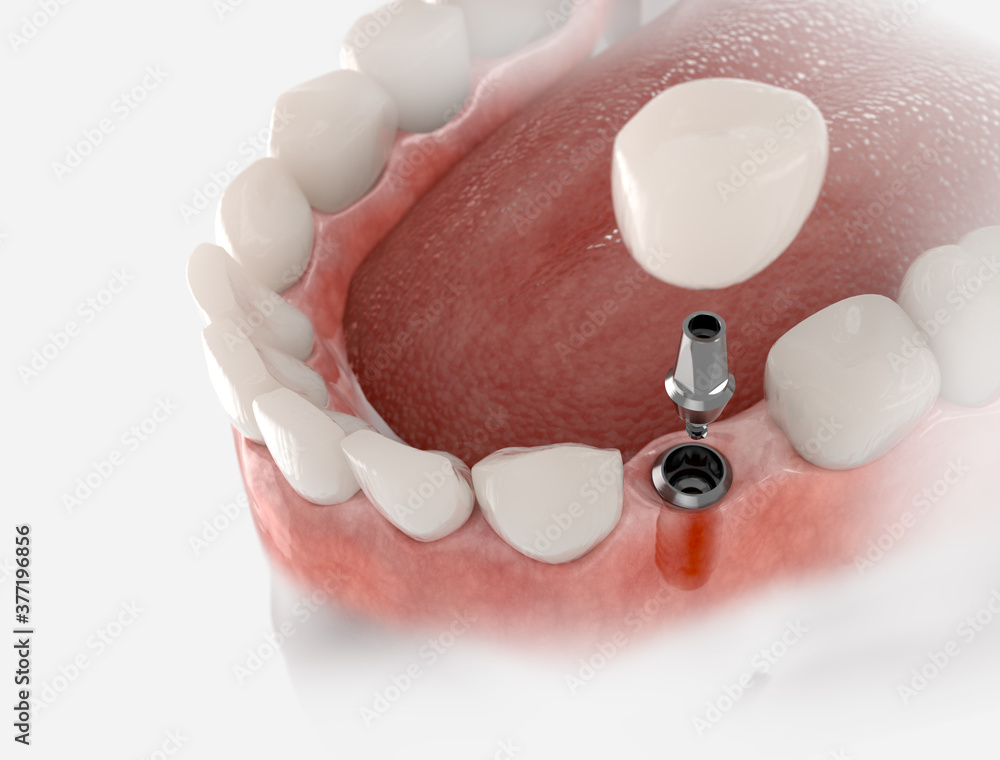 Dental crown, abutment and implant. 3D illustration of human teeth and
