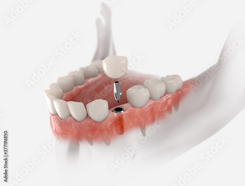 Dental crown, abutment and implant. 3D illustration of human teeth and dentures on white background. photo