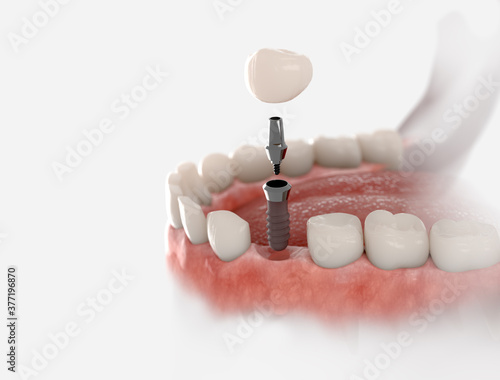 Tableau sur toile Dental crown, abutment and implant