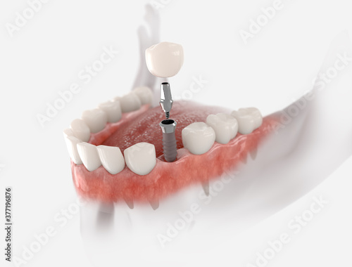 Dental crown, abutment and implant. 3D illustration of human teeth and dentures on white background.