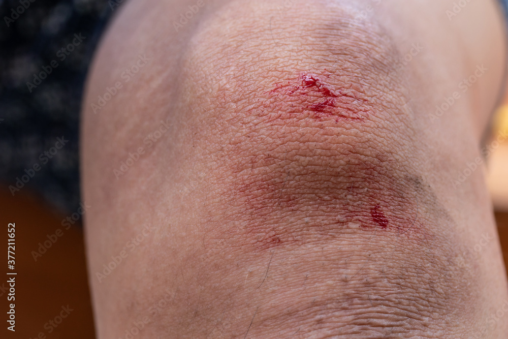 The knee is scratched. Close up on an bleeding scraped child his knee ...