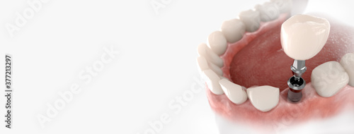 Dental crown, abutment and implant. 3D illustration of human teeth and dentures on white background. photo