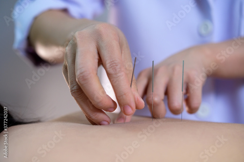 acupuncture young women.