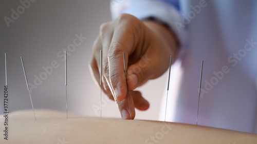 acupuncture young women.