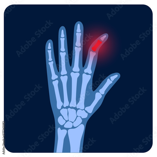 Arthrits x ray