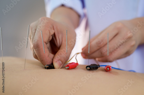 Electro-Acupuncture.Traditional Chinese acupuncture and Electro acupuncture on body of patient