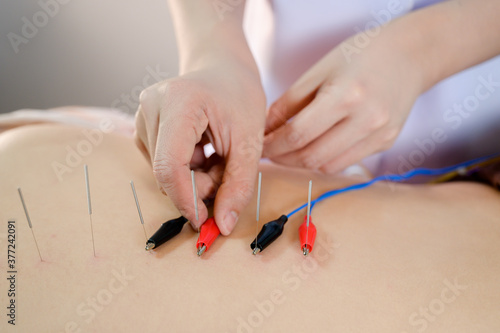 Electro-Acupuncture.Traditional Chinese acupuncture and Electro acupuncture on body of patient