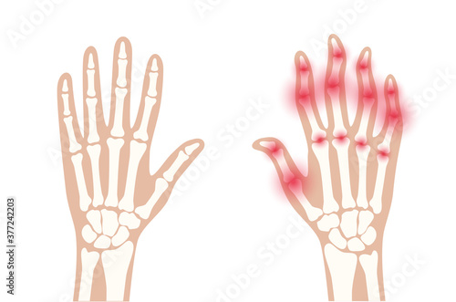 Arthrits x ray