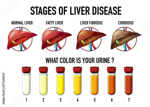 Stages of liver disease