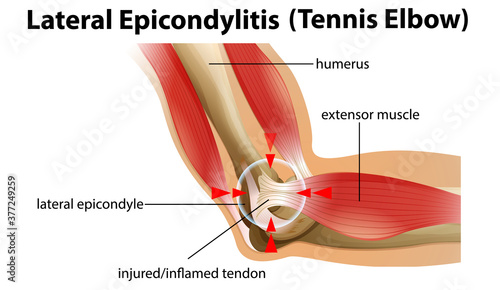 Lateral Epicondylitis or tennis elbow photo