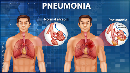 Comparison of healthy alveoli and Pneumonia