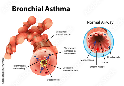 Asthma inflamed bronchial tube
