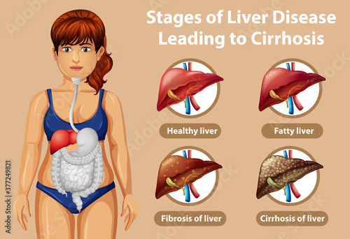 Stages of liver disease leading to Cirrhosis