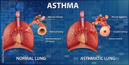 Comparison of healthy lung and Asthmatic lung