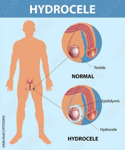 Medical poster showing different between male normal testicle and hydrocele