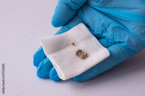 The gallbladder stones after ESWL intervention. Lithotripsy. Cholecystitis.