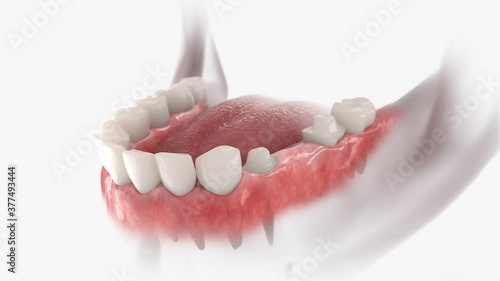 Bridge dental with 3 teeth fixed on molar and premolar. Animation of nstallation process. photo