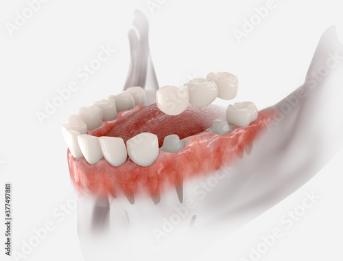 Bridge dental with 3 teeth fixed on molar and premolar. photo