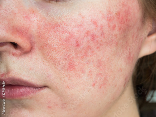 papulopustular rosacea, close-up of the patient's cheek photo