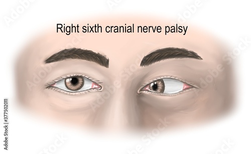 right abducen nerve palsy presents with lateral rectus palsy.